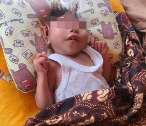 Bayi Tanpa Batok Kepala di Aceh Utara Butuh Bantuan Donatur